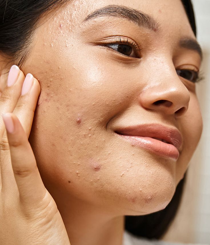 Signs your skin barrier may be compromised &mdash; recognising the signals