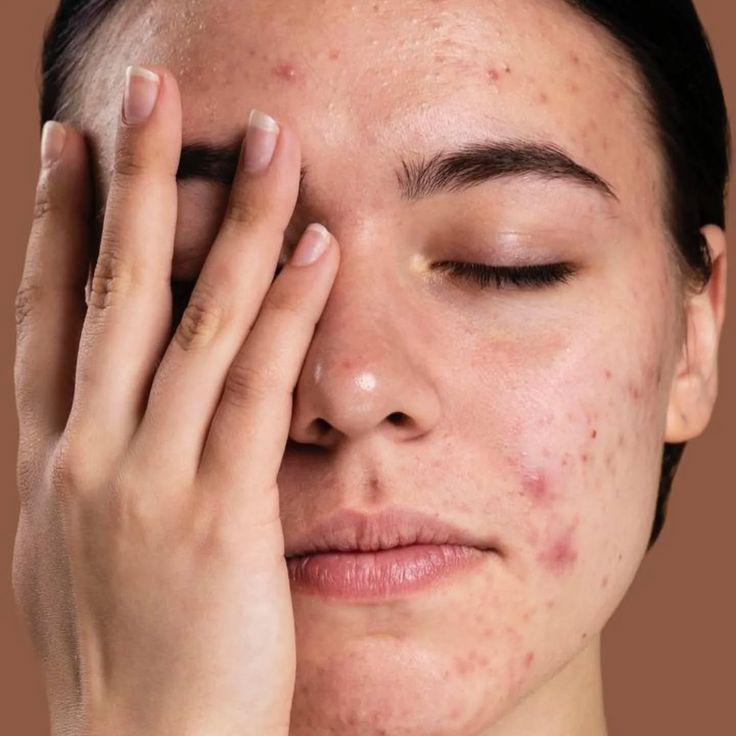 Common skincare myths that keep your skin barrier in a cycle of damage
