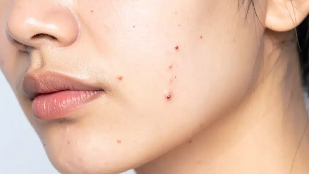 Pimples on Face Again? Why They Keep Coming Back and What Helps