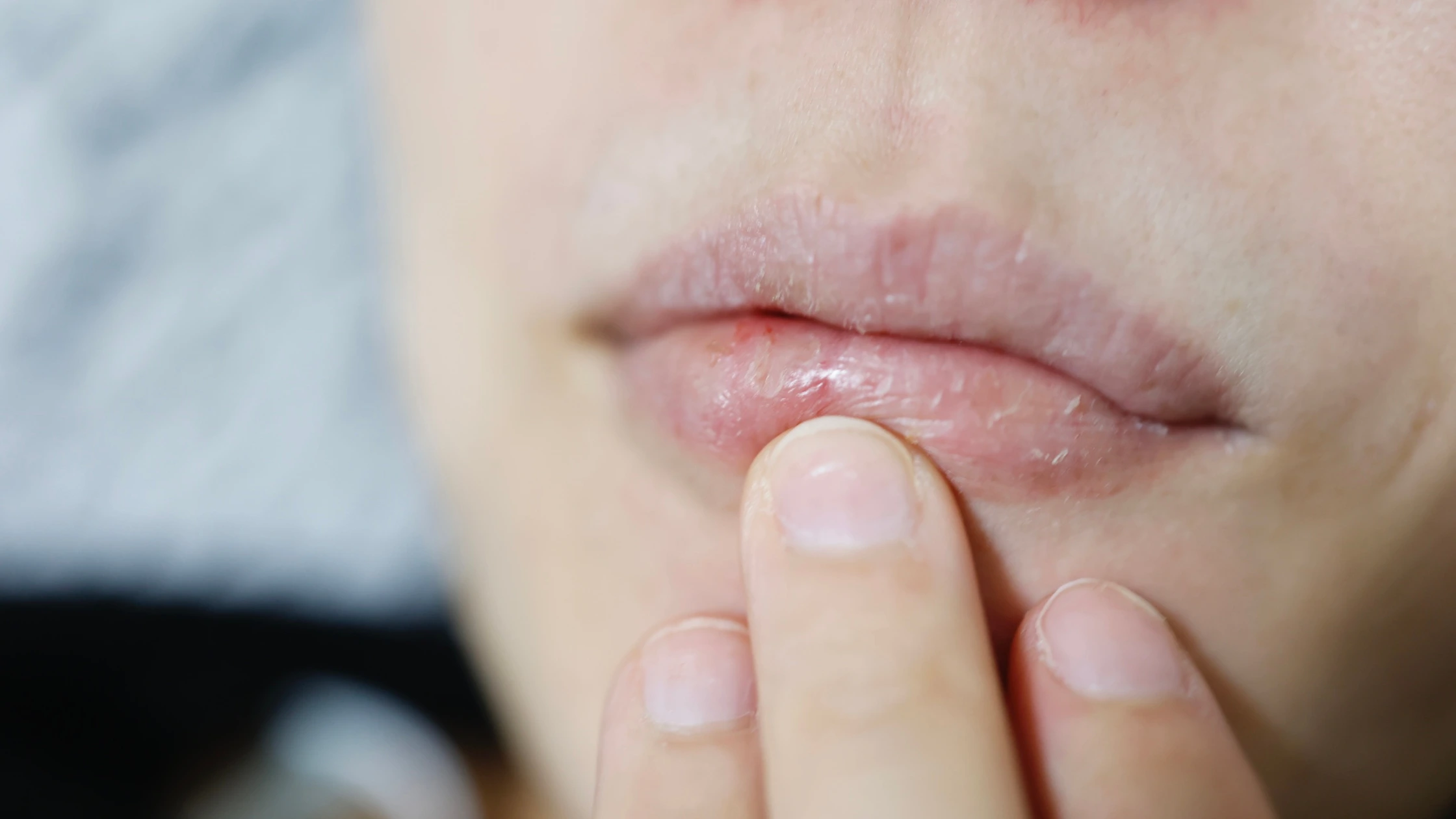 Dry lips home remedy and vitamin deficiency — what is safe and what actually helps
