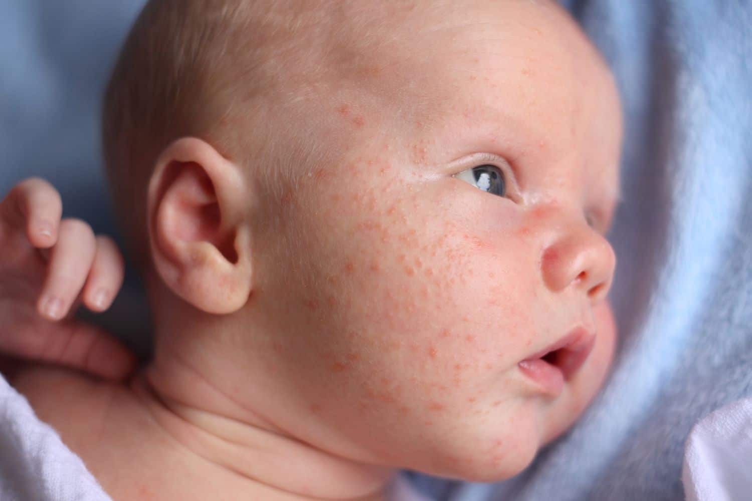 Newborn Acne vs Eczema vs Heat Rash: How to Tell the Difference